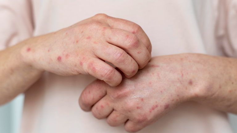 The expert described the symptoms of monkeypox virus: Attention those who experience fever and skin rash!