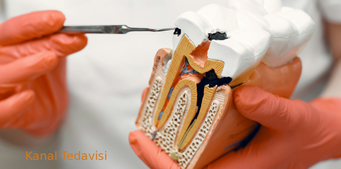 Kanal Tedavisi Yapılmazsa Ne Olur? İlerlemiş Çürüklerin Sonuçları