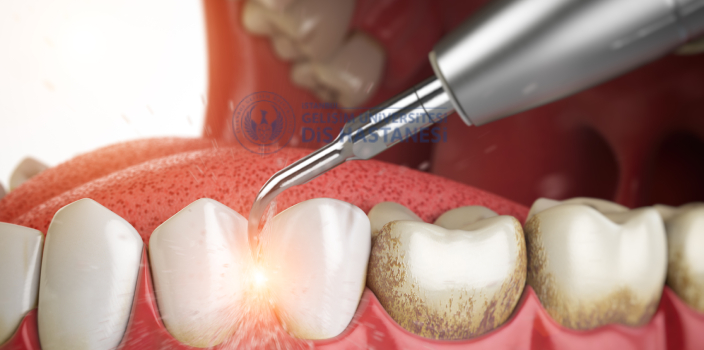 Diş Taşı Hangi Sıklıkla Temizlenmeli? Uzman Görüşleri