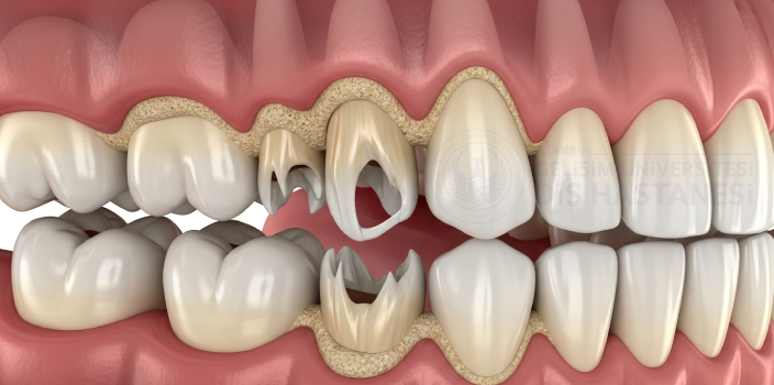 Diş Kırılması Durumunda İlk 30 Dakika Çok Önemli  Ne Yapmalı?