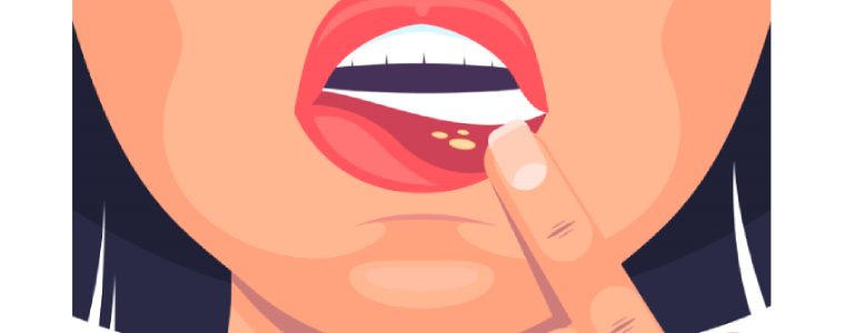 SIK Tekrarlayan Aft ve Uçuk Neden Olur? Tedavi Yöntemleri