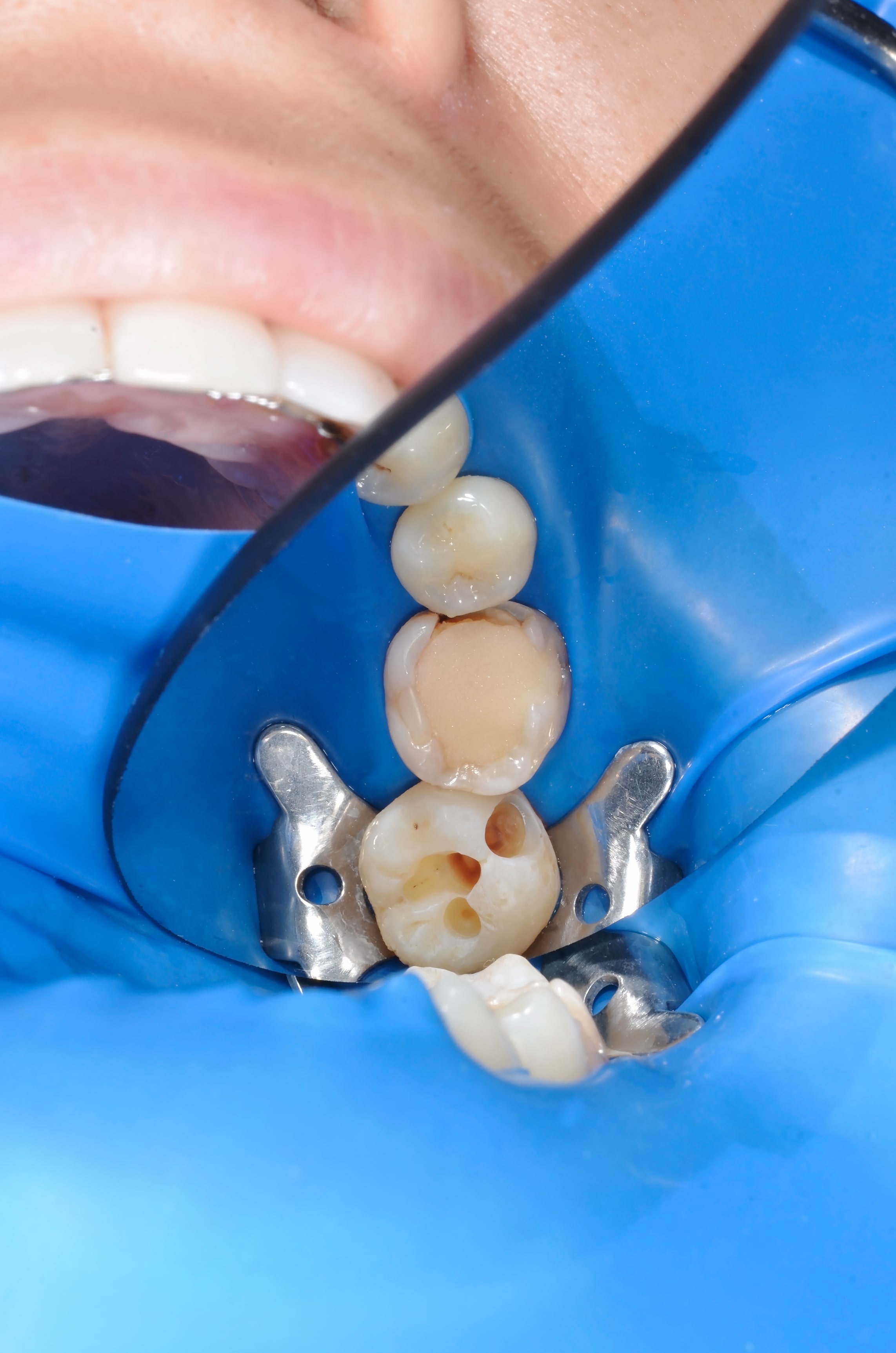 Ön Diş Dolgusu Nedir? Nasıl Yapılır?