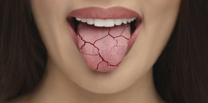 Uzun Oruç Saatlerinde Ağız Kuruluğuyla Başa Çıkma Rehberi