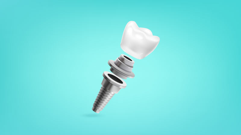 İmplant Vidası Takıldıktan Sonra Dikkat Edilmesi Gerekenler