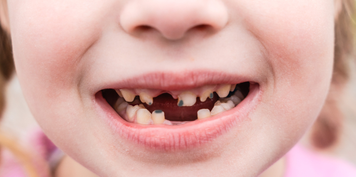 Süt Dişi Çürükleri İlerler mi? Ne Zaman Tedavi Gerektirir?
